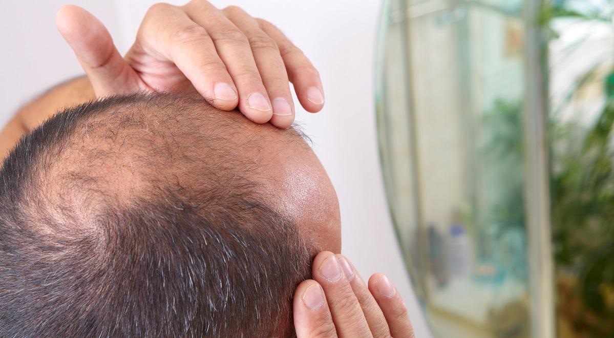 Przeszczep włosów – jak go zrobić, aby był skuteczny?