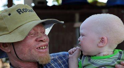 Międzynarodowy Dzień Świadomości na temat Albinizmu. Jak pomagać?